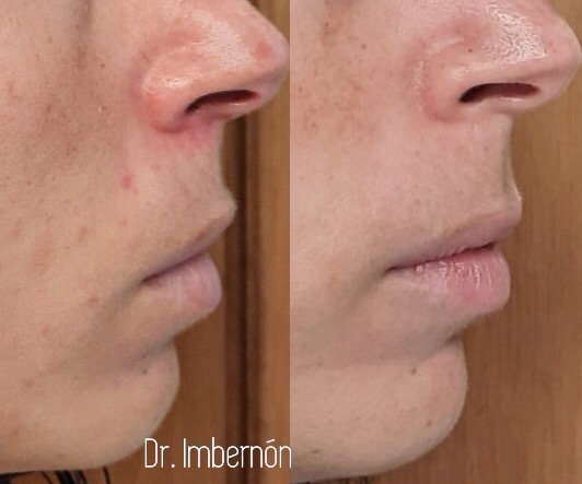 Rosácea - Presentación clínica